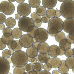 Sarcoma organoids help find targeted treatment