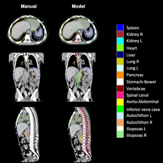 AI radiotherapy model enables faster and more consistent organ contouring