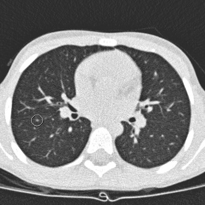 Suspicious spots on the lungs do not behave like metastases of rhabdomyosarcoma