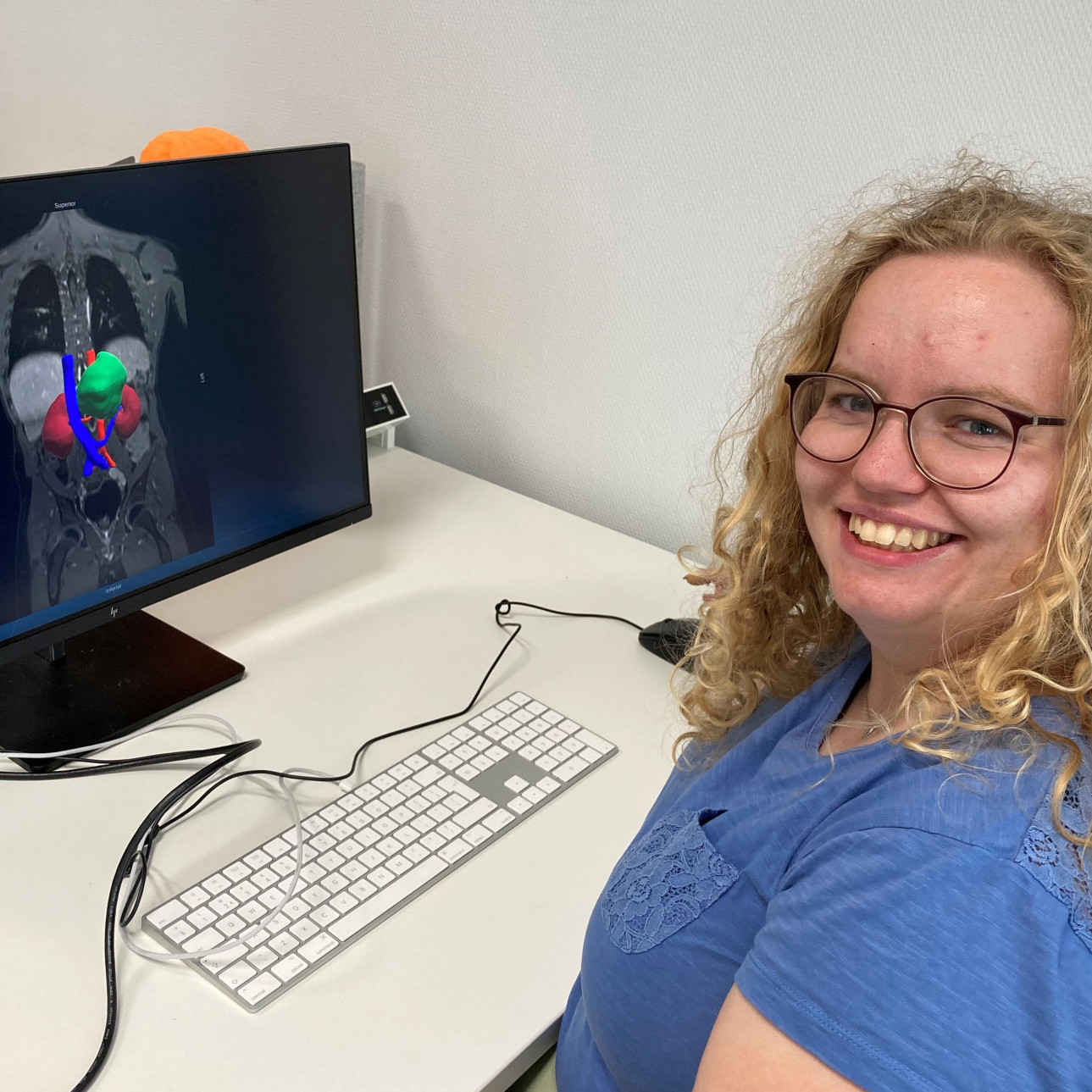 AI challenge to improve neuroblastoma surgeries